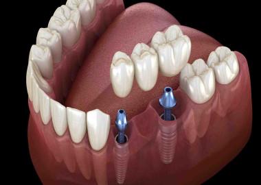 What is dental