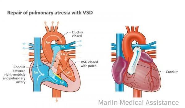 Is medical treatment sufficient to close ASDs and VSDs? Latest News on Medical Tourism, Latest News on Medical Tourism, Is medical treatment sufficient to close ASDs and VSDs?