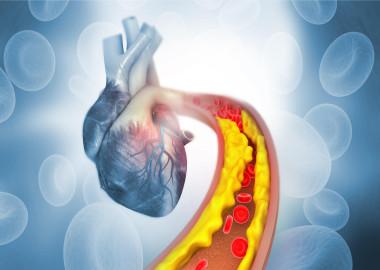 What is high cholesterol?