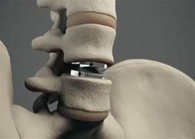 What is spinal disk replacement?
